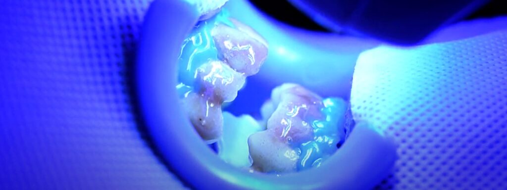Teeth whitening for yellow teeth