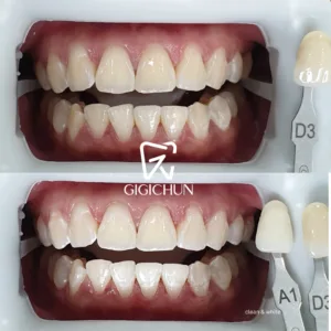 before and after clean and white gigichun