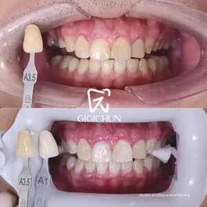 before and after clean and white gigichun