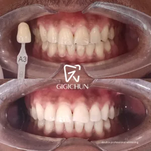 before and after clean and white gigichun