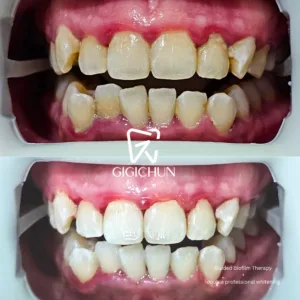 before and after clean and white gigichun