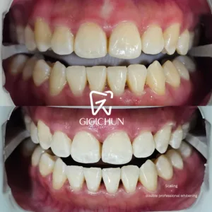 before and after clean and white gigichun