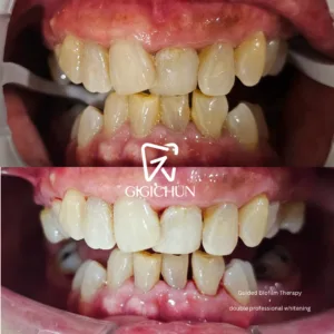 before and after clean and white gigichun