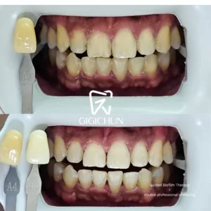 before and after clean and white gigichun
