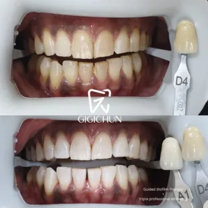 before and after clean and white gigichun