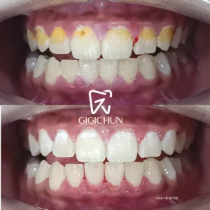 before and after clean and white gigichun