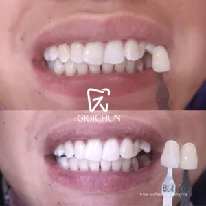 before and after clean and white gigichun