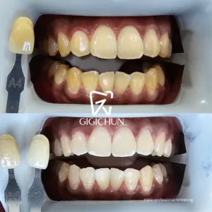 before and after clean and white gigichun