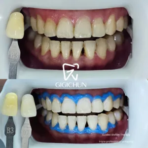 before and after clean and white gigichun