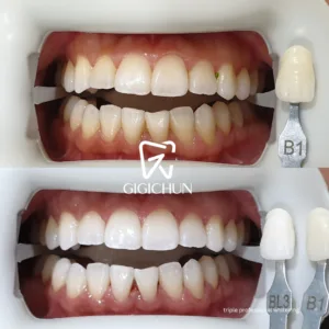 before and after clean and white gigichun