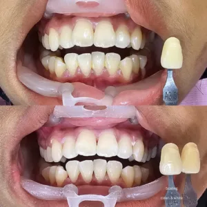 before and after clean and white gigichun