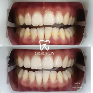 before and after clean and white gigichun