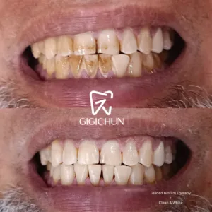 before and after clean and white gigichun