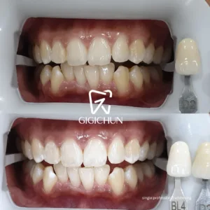 before and after clean and white gigichun