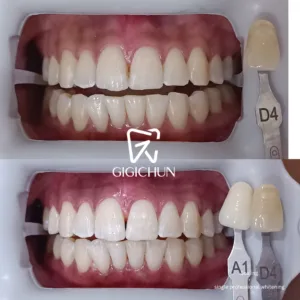 before and after clean and white gigichun