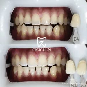 before and after clean and white gigichun