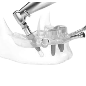 implant surgical guide
